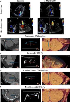 Percutaneous Coronary Sinus-Based Mitral Valve Repair Differentially Modulates Coronary Sinus to Mitral Valve Annulus Geometry and Topography